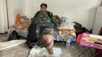 Önemsemedi bacakları bu duruma geldi! Yaşlı kadın müşterek an önceki tedavi iktisap etmek istiyor